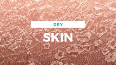 Relief From Cracked and Dry Skin | Richmond, VA Foot Doctors