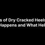 Causes of Dry Cracked Heels: Why It Happens and What Helps