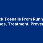 Black Toenails From Running: Causes, Treatment, Prevention